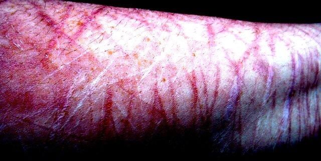 Bruised